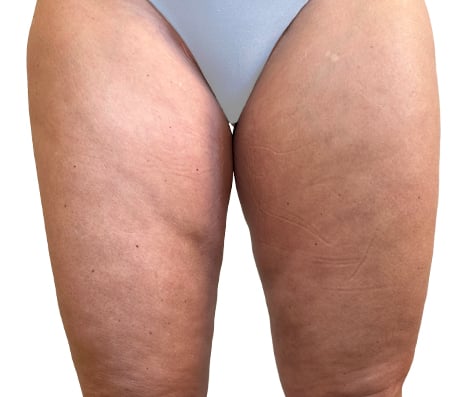 Dra Lívia Maria Camargo Subcisão para Celulite