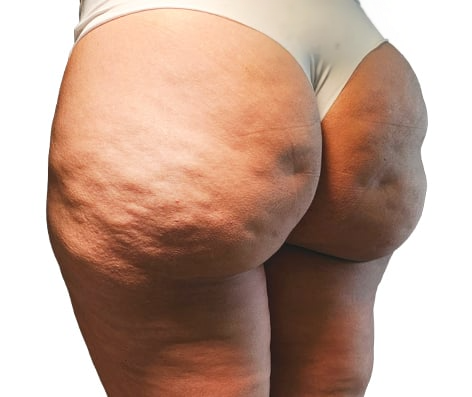 Dra Lívia Maria Camargo Subcisão para Celulite