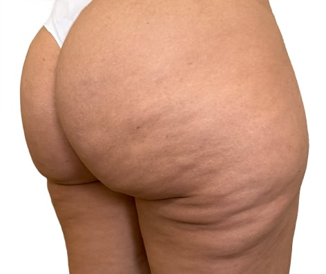 Dra Lívia Maria Camargo Subcisão para Celulite